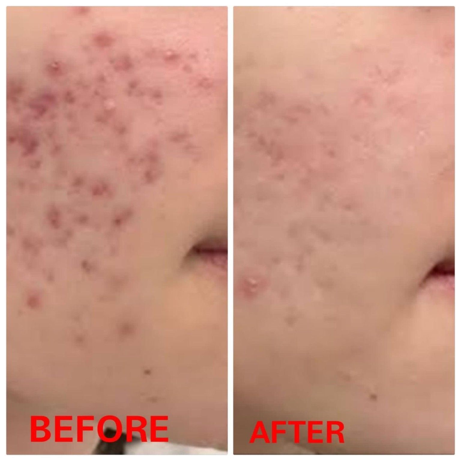 Psoriasis Recovery