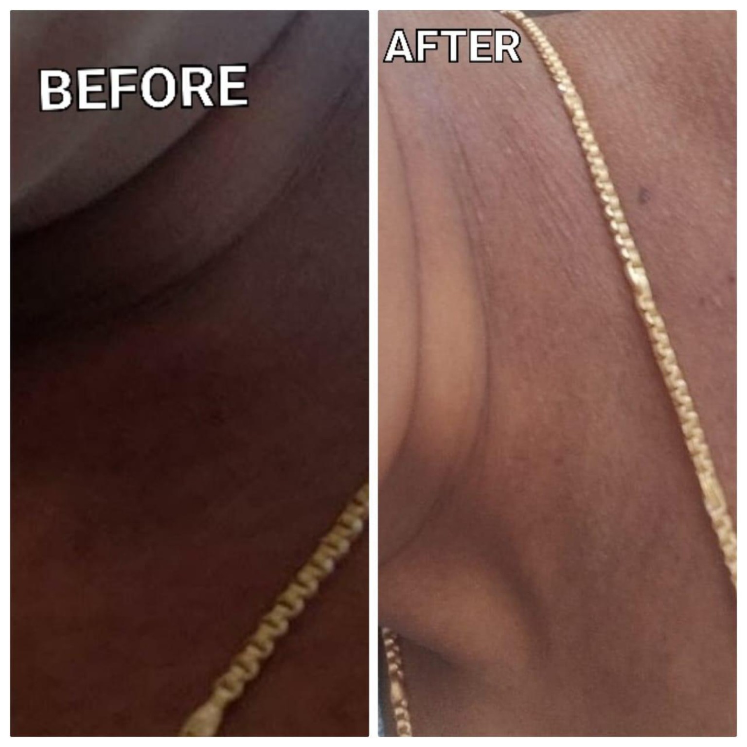 Eczema Healing