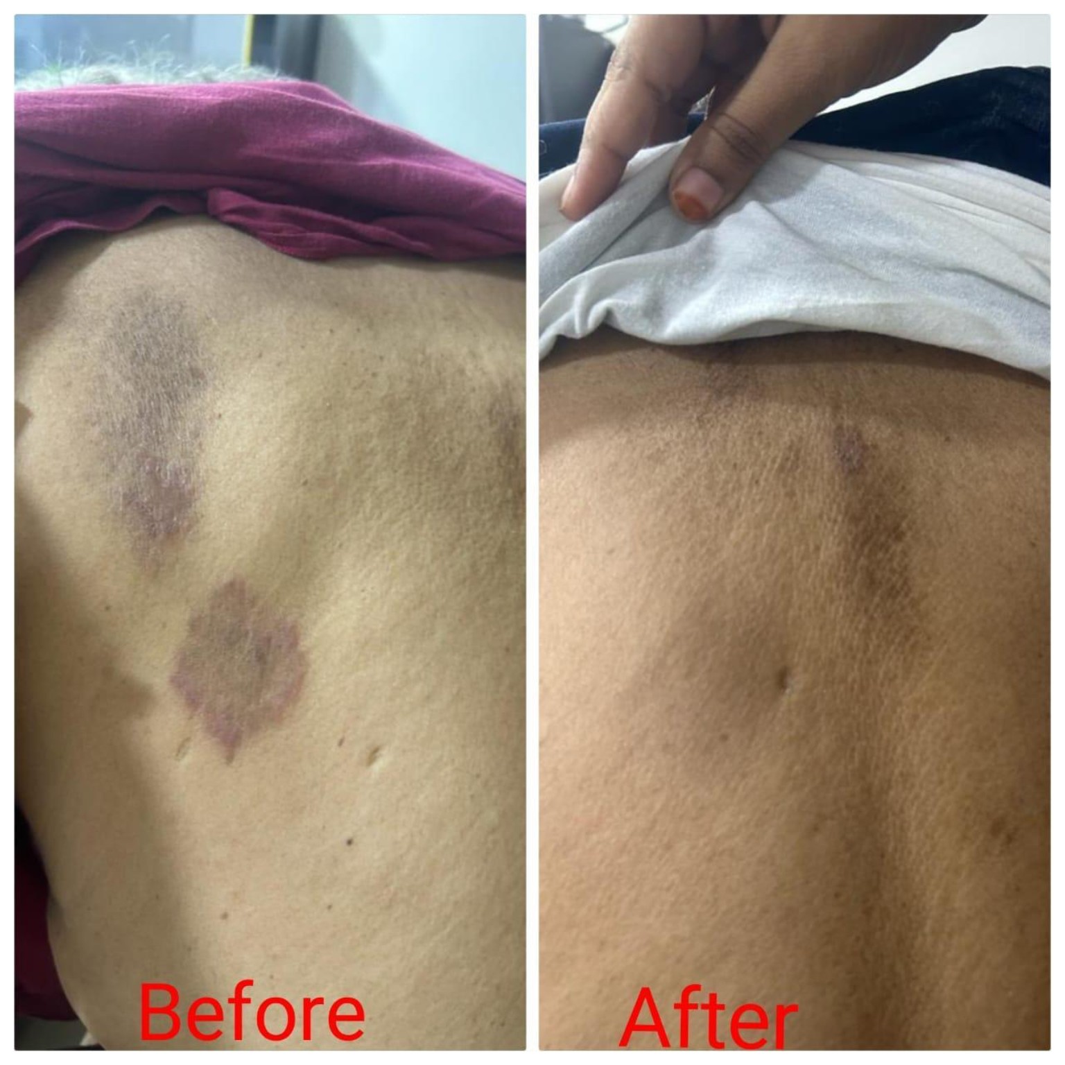 Acne Clearance